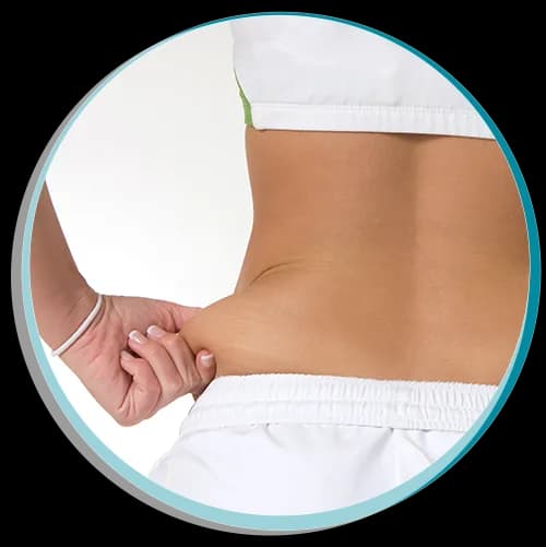 Zona abdominal tratada con criolipólisis Cooltech